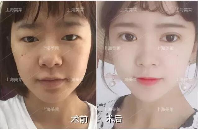 上海美莱整形割双眼皮的方法