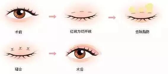 上海美莱整形割双眼皮的方法
